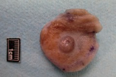 Melanoma of the skin: Mixed nodular and spindle cell type.