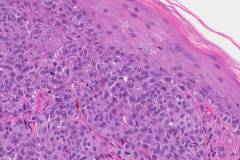 Nodular melanoma of the skin