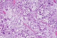 Invasive high grade papillary urothelial carcinoma