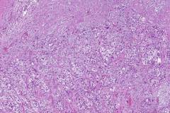 Invasive high grade papillary urothelial carcinoma