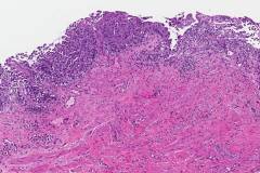 Invasive and in situ urothelial carcinoma