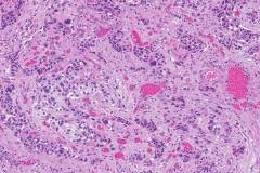 Urothelial carcinoma of the bladder