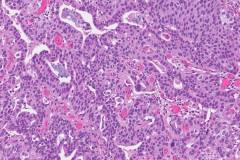 Urothelial carcinoma with glandular differentiation