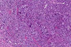 Urothelial carcinoma of the bladder