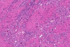 Urothelial carcinoma of the bladder