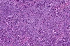 Lymphoepithelioma-like urothelial carcinoma of the bladder