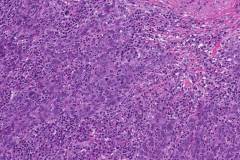 Lymphoepithelioma-like urothelial carcinoma of the bladder