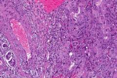 Urothelial carcinoma of the bladder