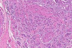 Micropapillary type urothelial carcinoma of the bladder