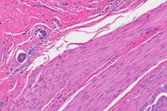 Micropapillary type urothelial carcinoma of the bladder