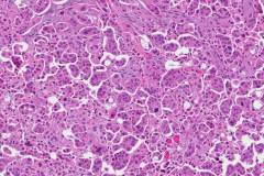 Micropapillary type urothelial carcinoma of the bladder