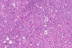 Metastatic urothelial carcinoma to a lymph node