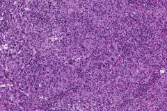 Lymphoepithelial-like urothelial carcinoma