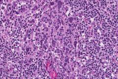 Lymphoepithelial-like urothelial carcinoma