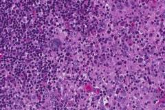 Lymphoepithelial-like urothelial carcinoma