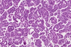 Micropapillary urothelial carcinoma