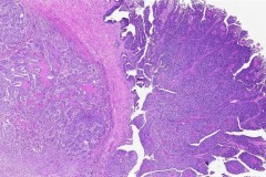 Invasive high grade papillary urothelial carcinoma of the bladder