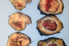 Poorly differentiated urothelial carcinoma of the bladder