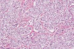 Urothelial carcinoma: Clear cell variant