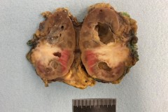 Urothelial carcinoma of the renal pelvis