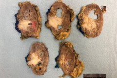 Urothelial carcinoma of the renal pelvis