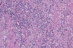 Urothelial carcinoma: Plasmacytoid variant