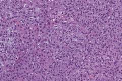 Poorly differentiated urothelial carcinoma of the bladder