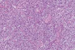 Poorly differentiated urothelial carcinoma of the bladder with squamous differentiation