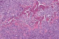 Sarcomatoid urothelial carcinoma with osteosarcomatous differentiation