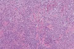 Sarcomatoid urothelial carcinoma with osteosarcomatous differentiation