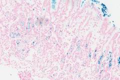 Erosive iron gastropathy