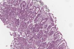 Erosive iron gastropathy