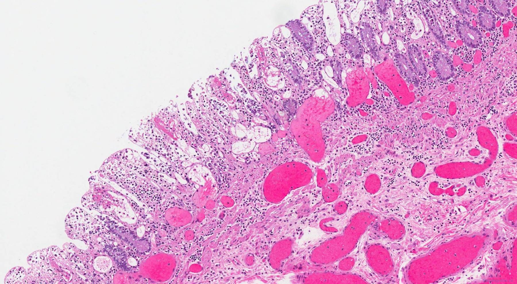 Ischemic colitis Atlas of Pathology