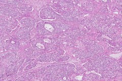 Juvenile granulosa cell tumour of the ovary