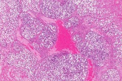 Juvenile granulosa cell tumour of the ovary