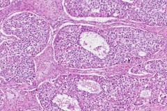 Juvenile granulosa cell tumour of the ovary