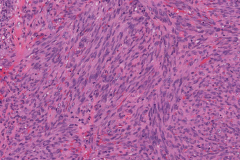 Kaposi sarcoma of the skin