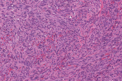 Kaposi sarcoma of the skin