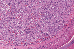 Kaposi sarcoma of the skin