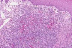 Kaposi sarcoma of the skin