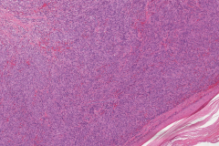 Kaposi sarcoma of the skin