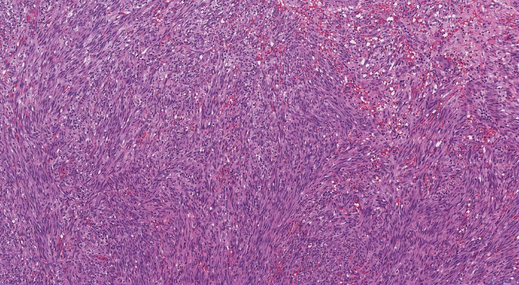 Kaposi Sarcoma 