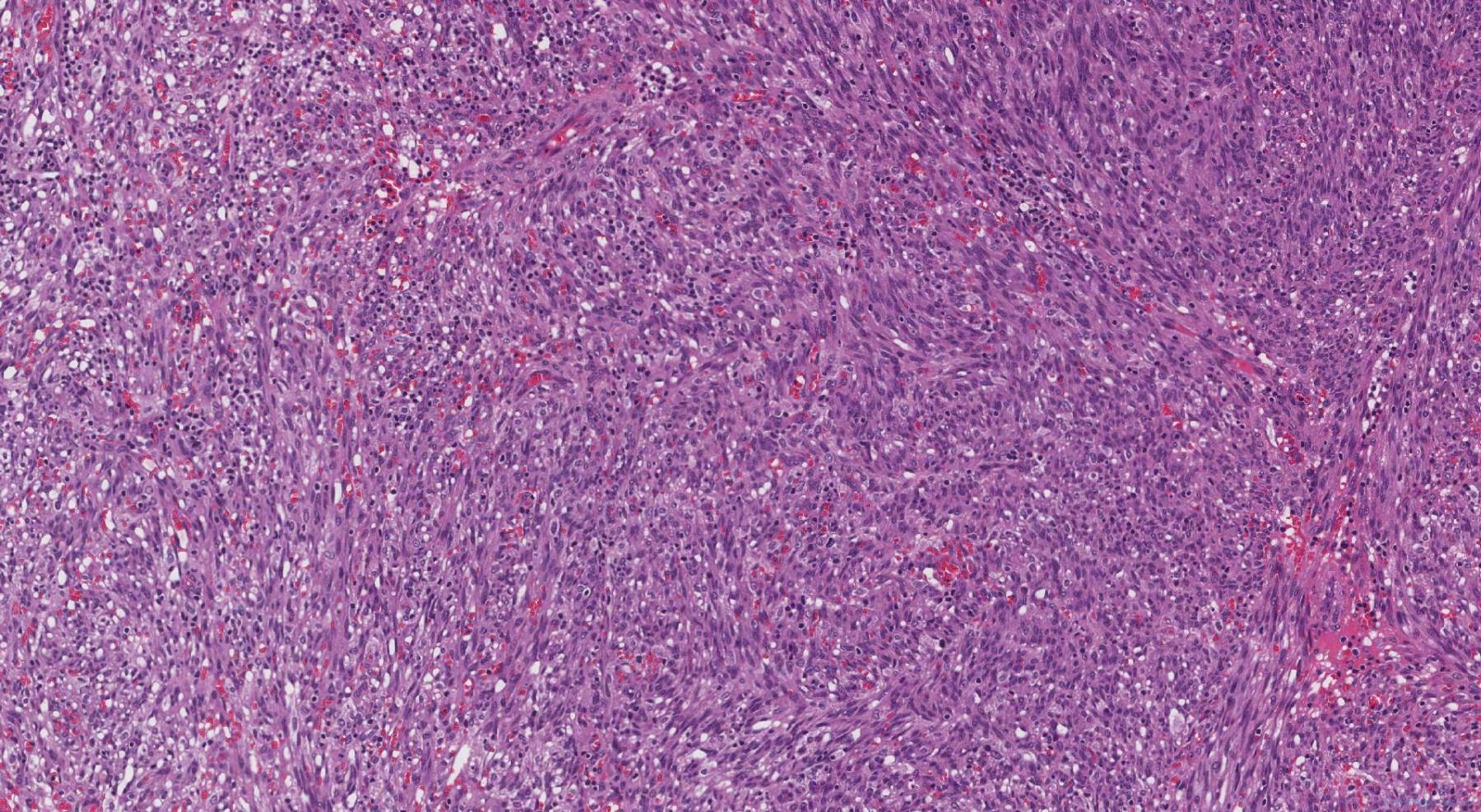 Kaposi sarcoma | Atlas of Pathology