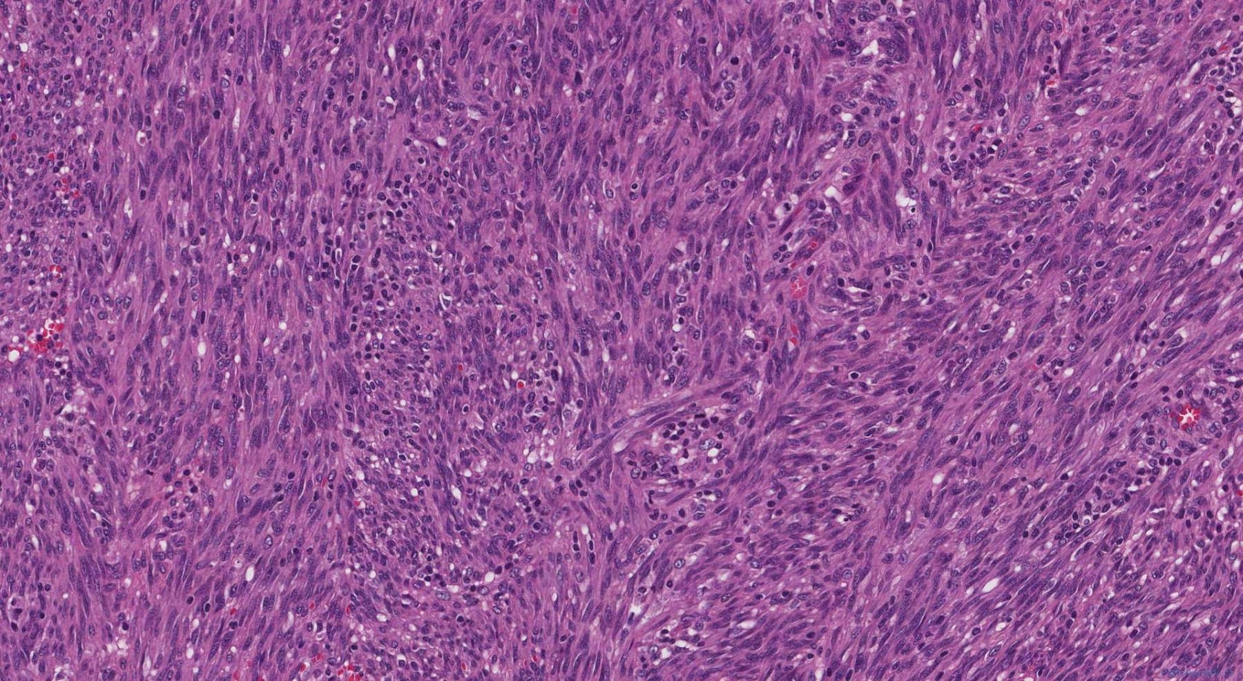 Kaposi Sarcoma 