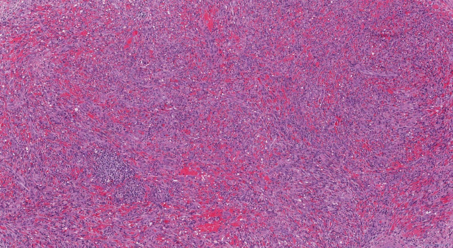 Kaposi Sarcoma | Atlas Of Pathology