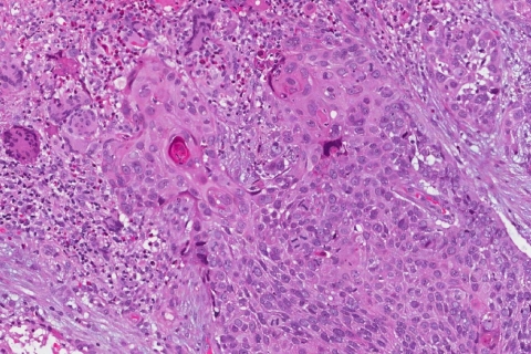 Hpv-independent Squamous Cell Carcinoma Of The Oropharynx 