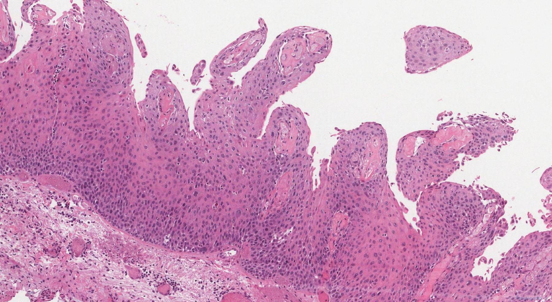 Keratinizing squamous dysplasia of the larynx | Atlas of Pathology