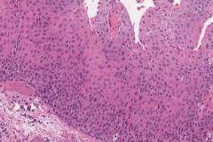 Moderate to severe keratinizing squamous dysplasia of the larynx