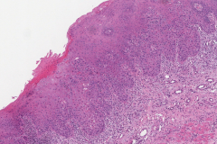 Severe keratinizing squamous dysplasia of the oral tongue