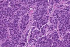 Large cell neuroendocrine carcinoma of the lung